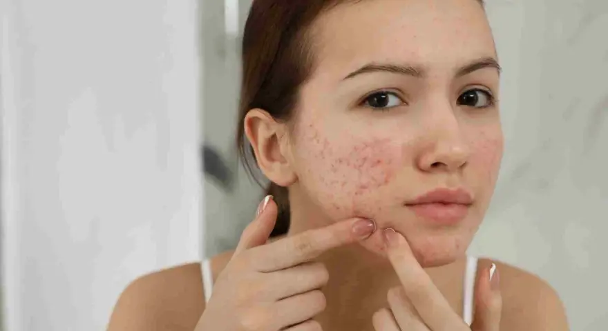 Viso di giovane donna con rossori e brufoli, un segno comune di acne in gravidanza.