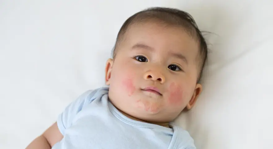 Bambino con guance arrossate e screpolate, forse per la differenza tra dermatite atopica e seborroica.