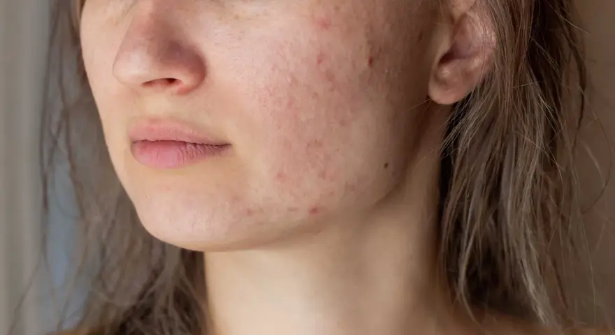 Primo piano del viso di una giovane donna con pelle arrossata e imperfezioni, tipiche dell'acne aestivalis.