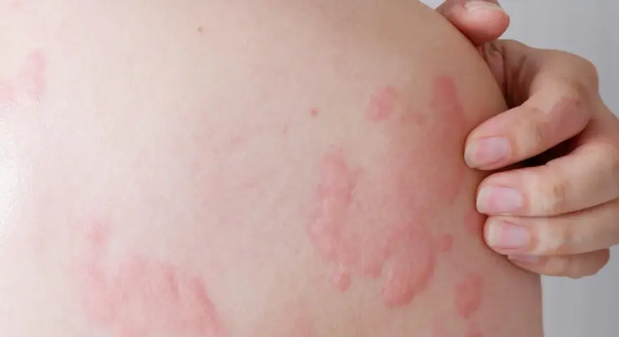 Pelle con pomfi rossi e pruriginosi, sintomo di orticaria solare. Una mano sfiora la zona colpita.