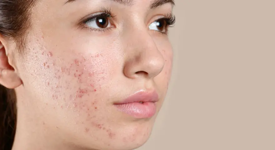 Primo piano del viso di una giovane donna con evidenti bollicine sul viso, segno di acne.