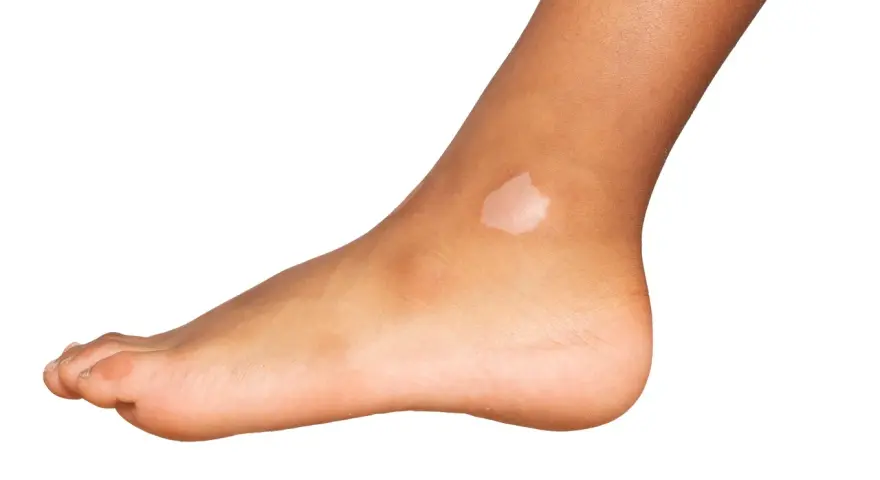 Piede con macchie bianche sulla pelle, segno di mancanza di melanina dopo l'esposizione al sole.