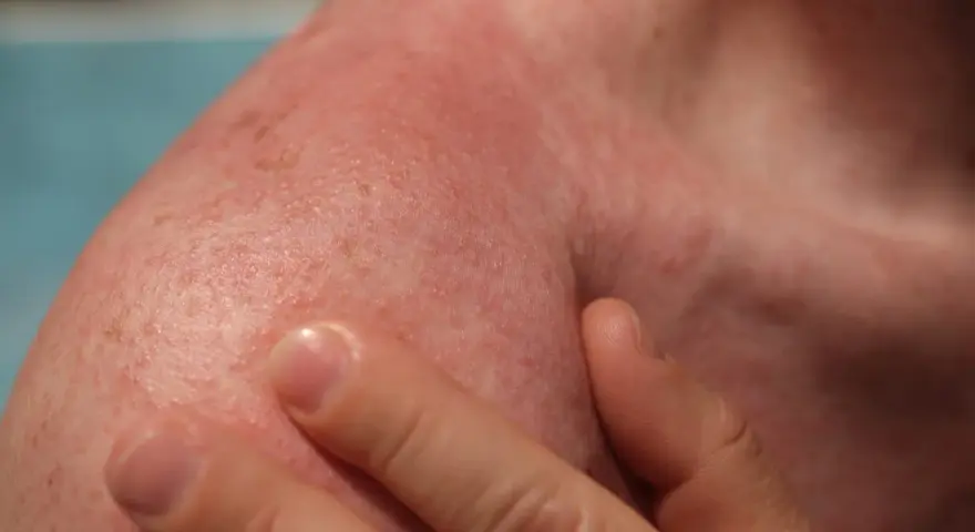 Spalla arrossata e irritata, con piccoli puntini rossi. Potrebbe essere necessario cercare rimedi eritema solare.