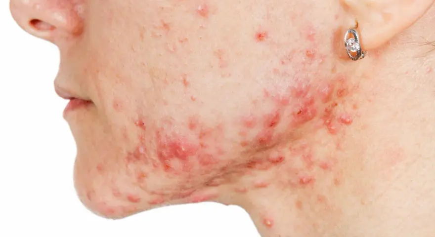 Primo piano del viso di una persona con acne, con un brufolo che non va via e arrossamenti evidenti.