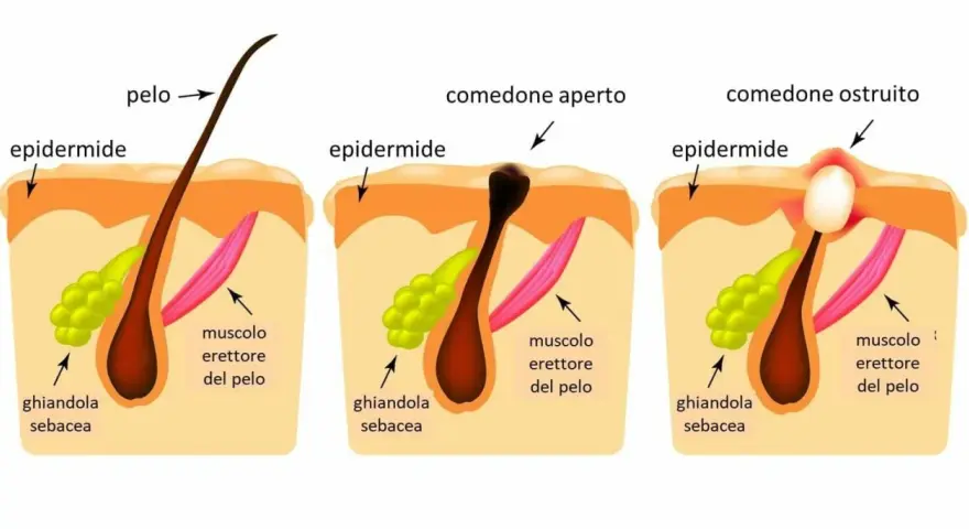Illustrazione che spiega perchè escono i brufoli: un poro ostruito da sebo e cellule morte causa infiammazione.