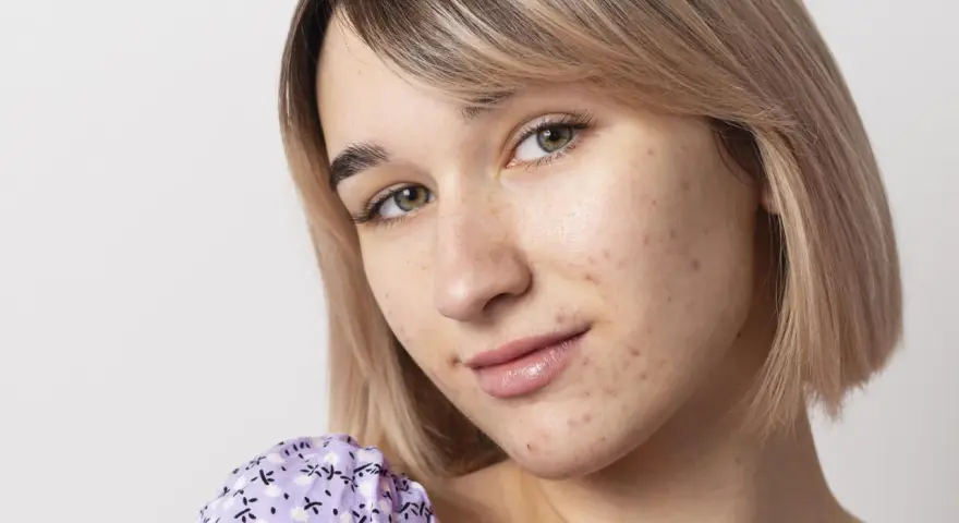 Primo piano di una giovane donna con pelle chiara e capelli biondi, che mostra segni di acne da sudore sul viso.