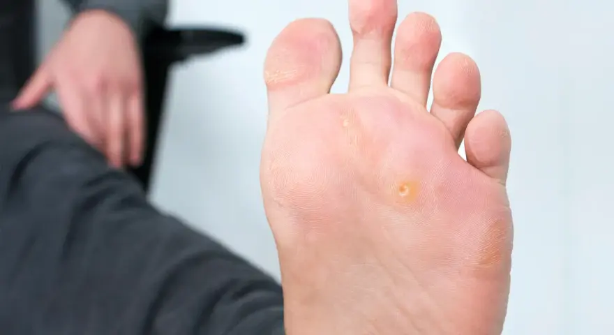 Primo piano di un piede con un occhio di pernice. Scopri come toglierlo facilmente.