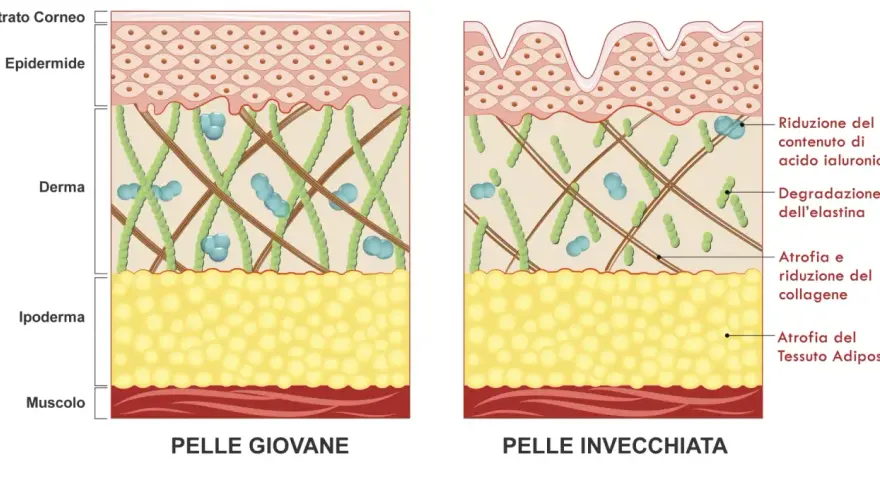 Confronto tra pelle giovane e pelle invecchiata: l'invecchiamento della pelle mostra riduzione di acido ialuronico, collagene, elastina e tessuto adiposo.