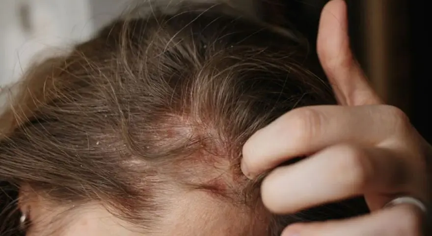 Dita che grattano un cuoio capelluto arrossato e dolorante, con evidenti squame bianche tra i capelli castani.