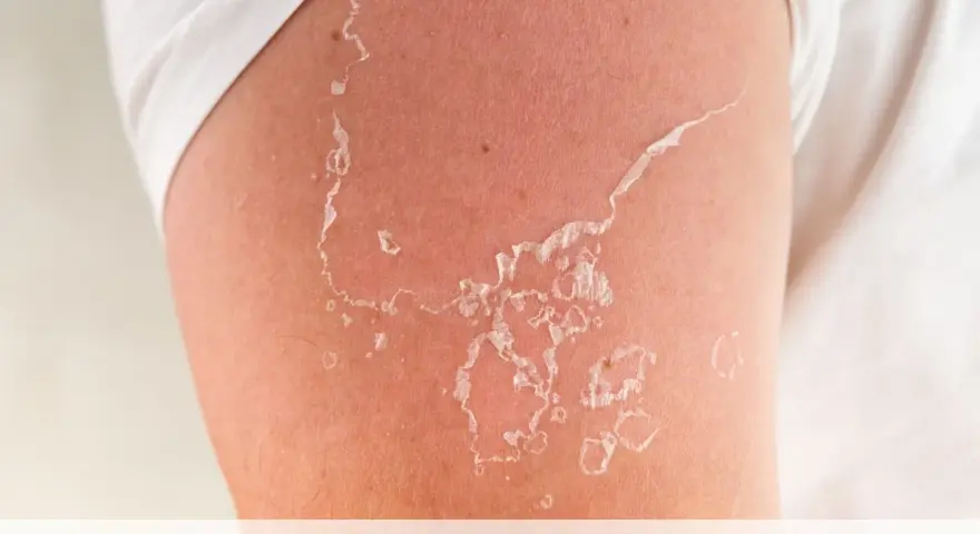 Pelle che si desquama dopo un'esposizione solare. Scopri come togliere la pelle morta dal corpo in modo delicato.