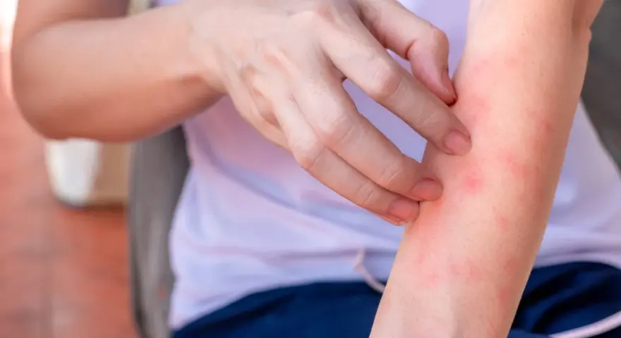 Mano che si gratta un braccio arrossato, con piccoli sfoghi che ricordano l'eczema sulle gambe.