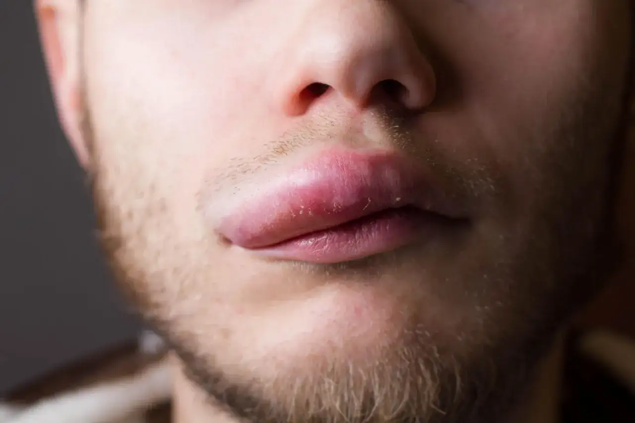 Primo piano di un uomo con un labbro gonfio e arrossato, forse a causa di una reazione allergica o un'irritazione.
