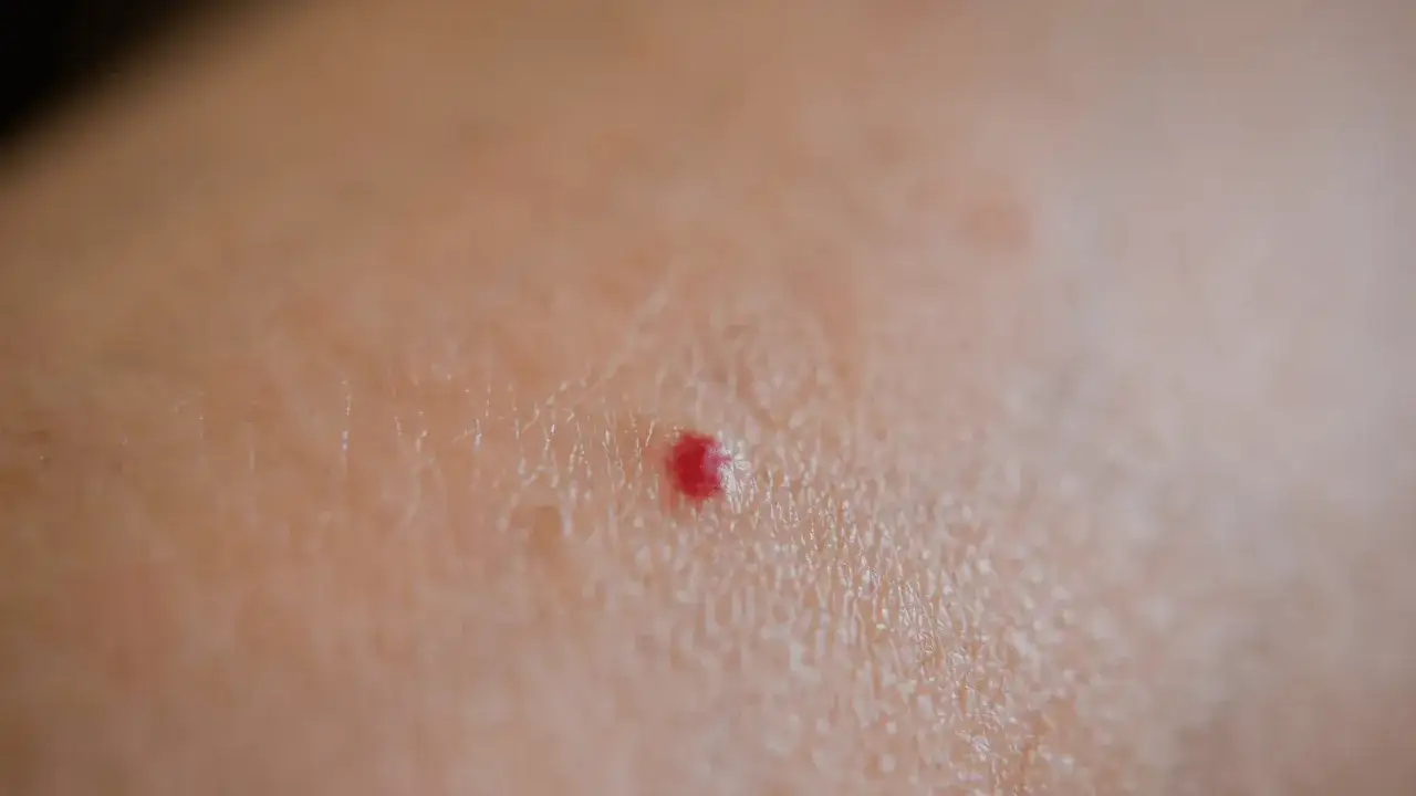 Piccola macchia rossa sulla pelle, tipo bruciatura, che prude.
