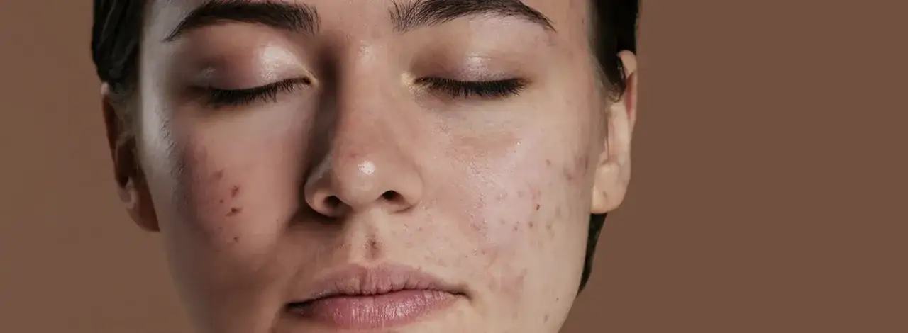Primo piano del viso di una giovane donna con imperfezioni cutanee, che suggeriscono un invecchiamento precoce.