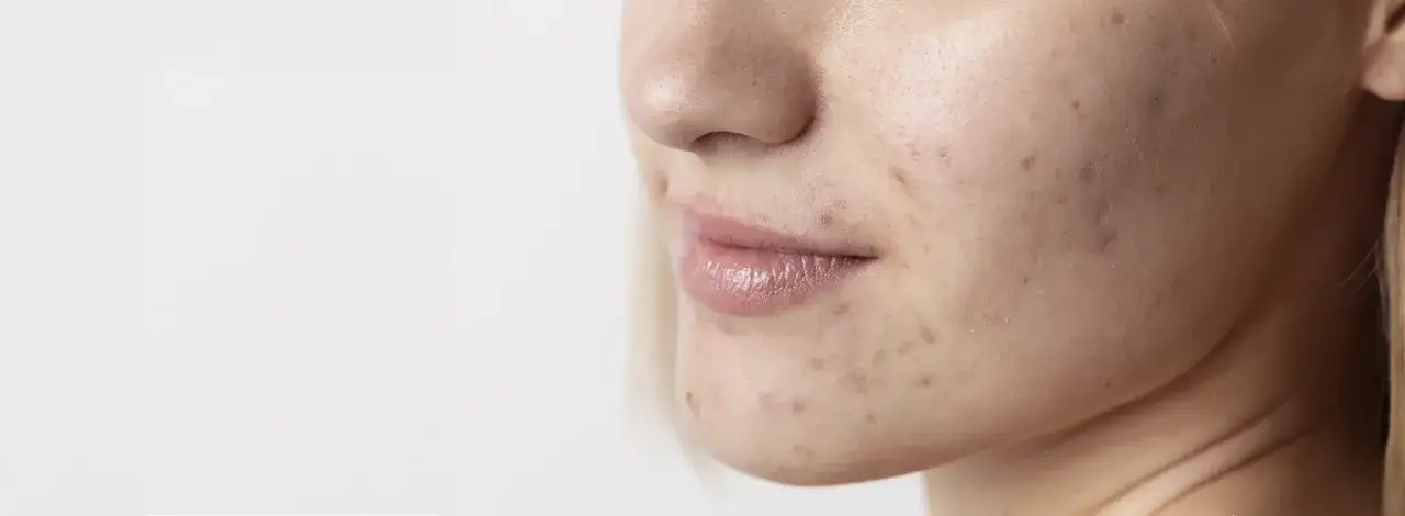 Primo piano del viso di una donna con macchie da acne. Scopri come togliere le macchie da acne per una pelle più liscia.