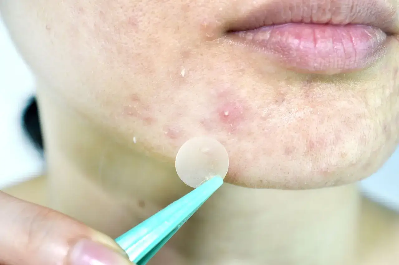 Pelle con brufoli trattata con cerotto. Un cerotto per brufoli viene applicato con una pinzetta, un modo per non schiacciare i brufoli.