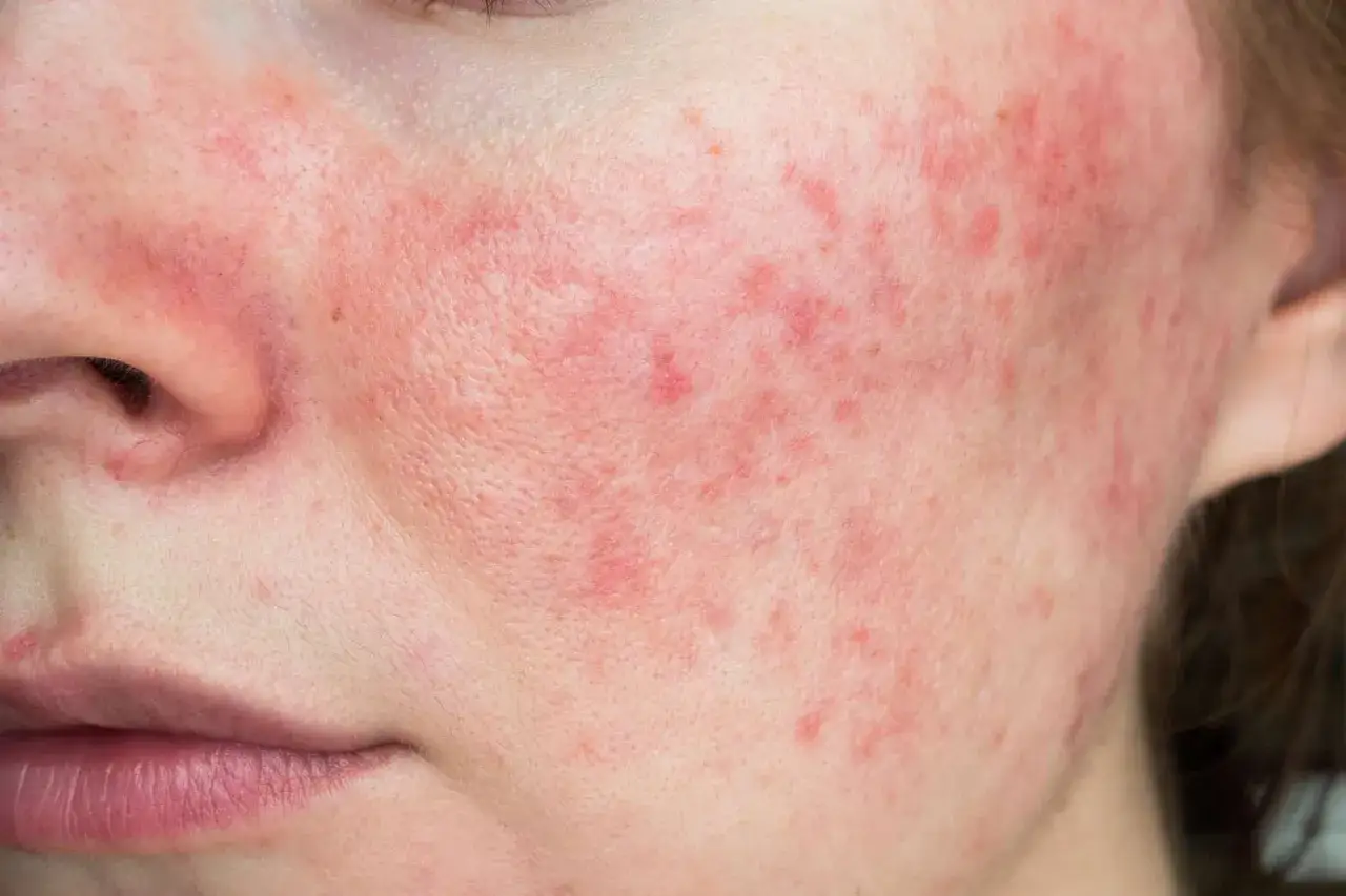 Primo piano del viso con arrossamento diffuso e piccole pustole, indicativo di dermatite viso.
