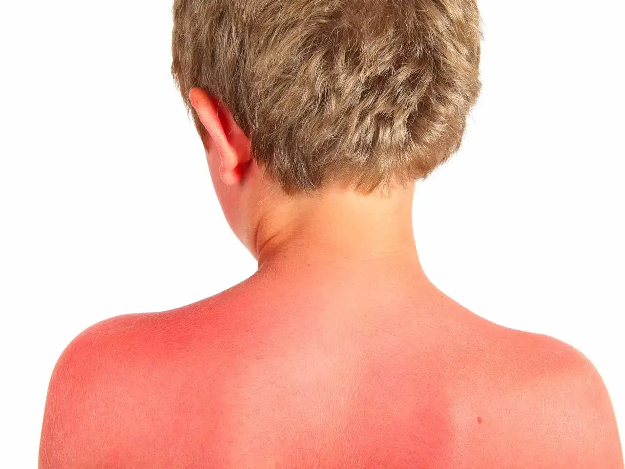 Spalle e collo arrossati dal sole, un esempio di eritema solare. Cercare rimedi efficaci per alleviare il bruciore.
