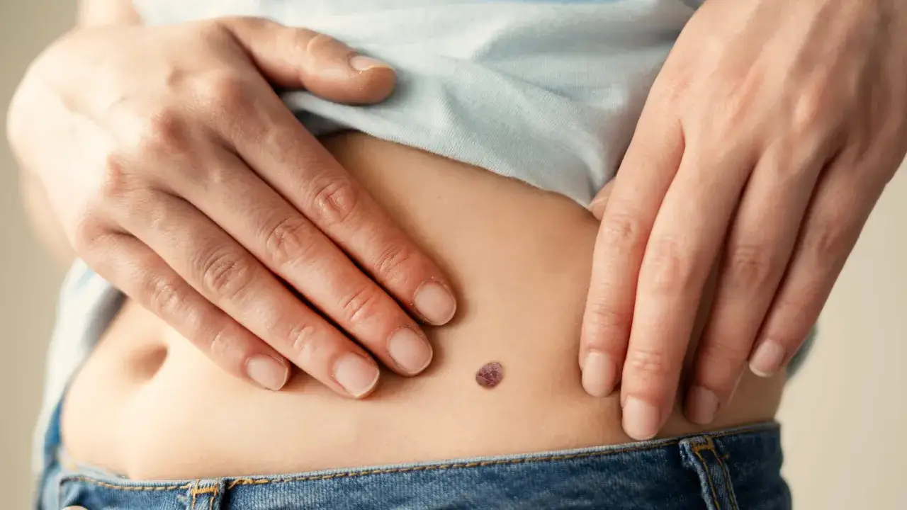 Mano che indica un neo scuro sulla pancia, con un piccolo brufolo che spunta dal neo.