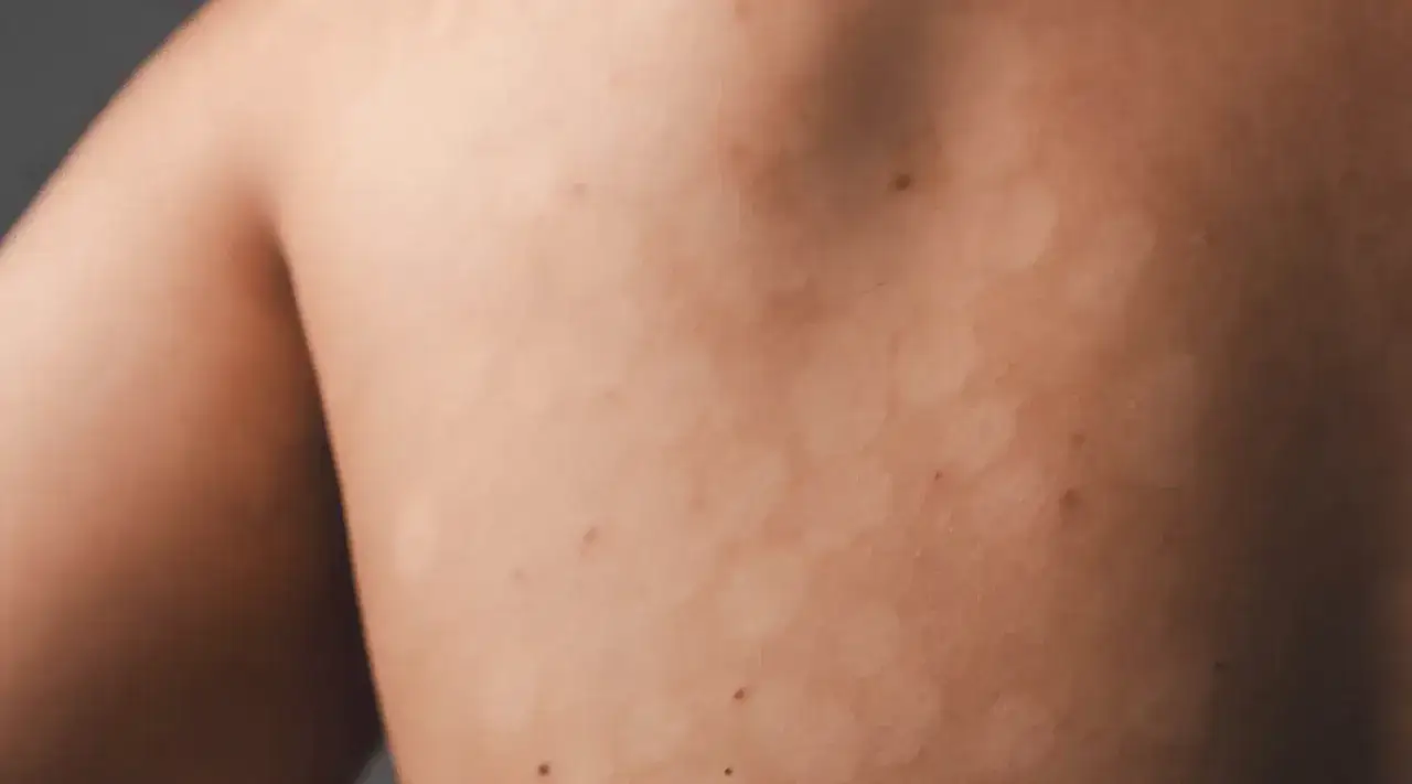 Macchie chiare sulla schiena, possibili sintomi di micosi o dermatite da stress senza prurito.