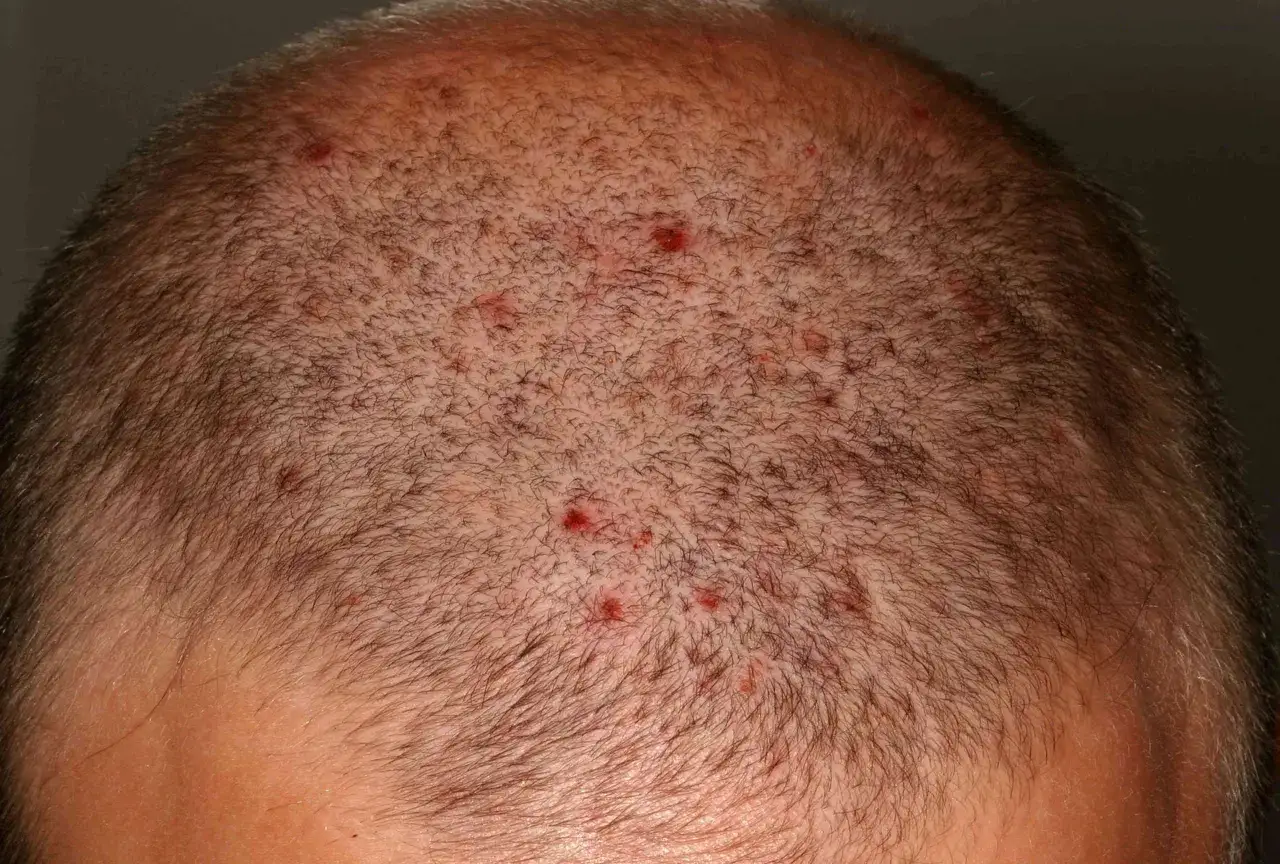 Cuoio capelluto arrossato e dolorante con piccole pustole rosse e infiammazioni.