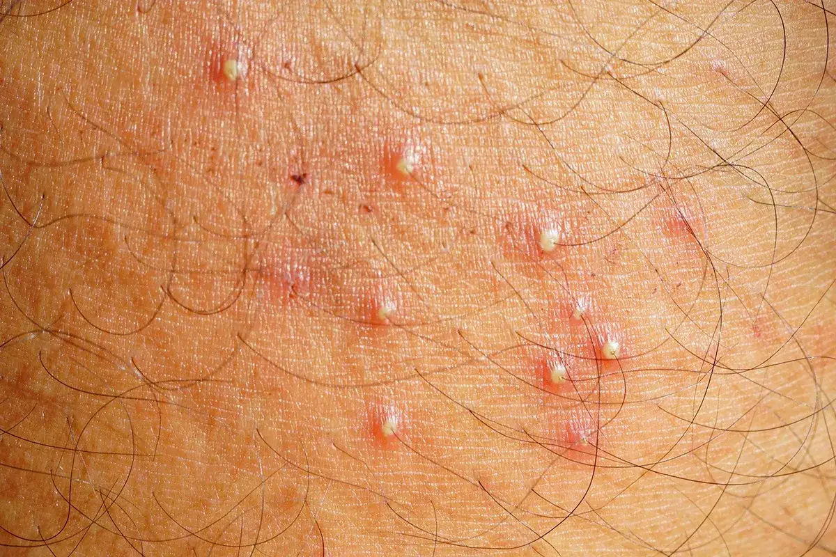 Pelle delle gambe con irritazione e piccoli brufoli, alcuni con peli sottopelle visibili.