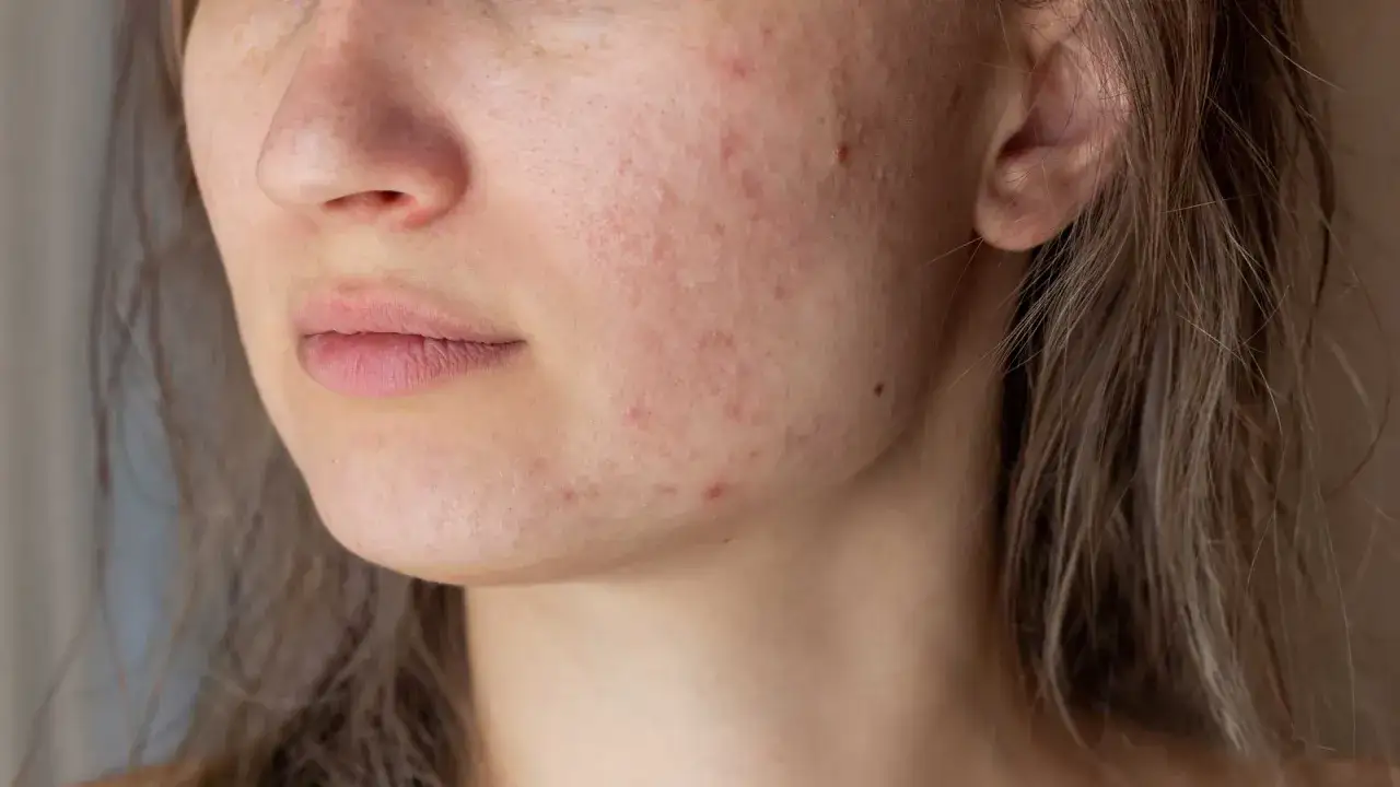 Primo piano del viso di una giovane donna con pelle arrossata e imperfezioni, tipiche dell'acne aestivalis.