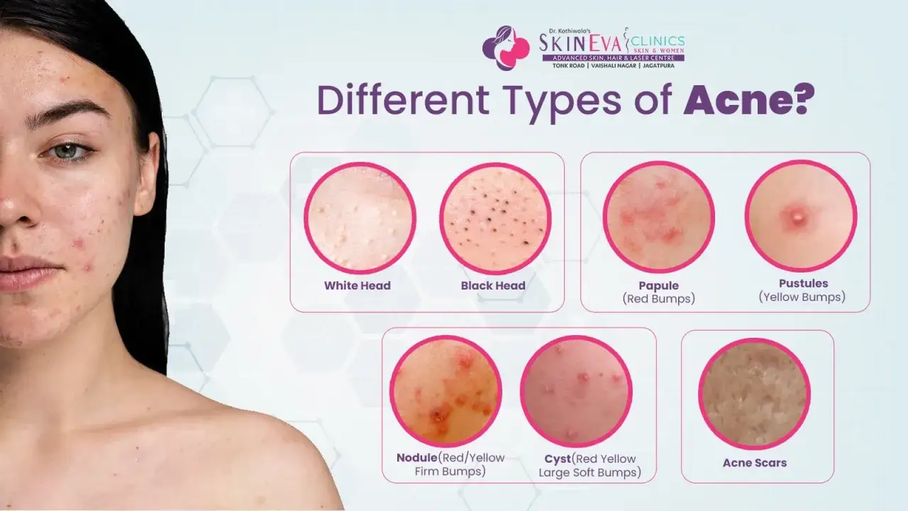 Primo piano di un viso con diverse forme di bollicine sul viso, tra cui whitehead, blackhead, papule, pustole, noduli, cisti e cicatrici da acne.