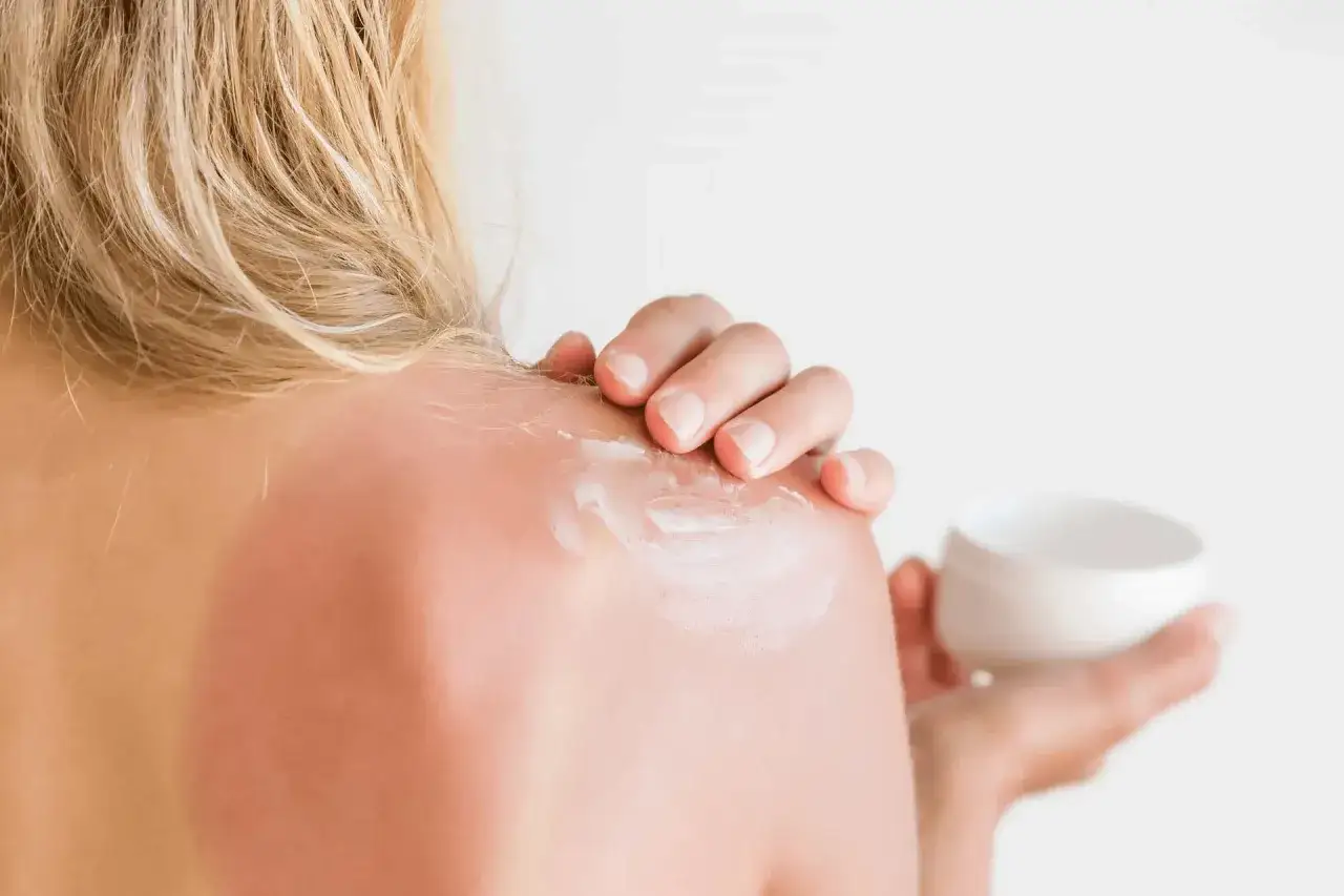 Spalla arrossata dal sole, con crema applicata per alleviare il bruciore e il prurito da eritema solare.