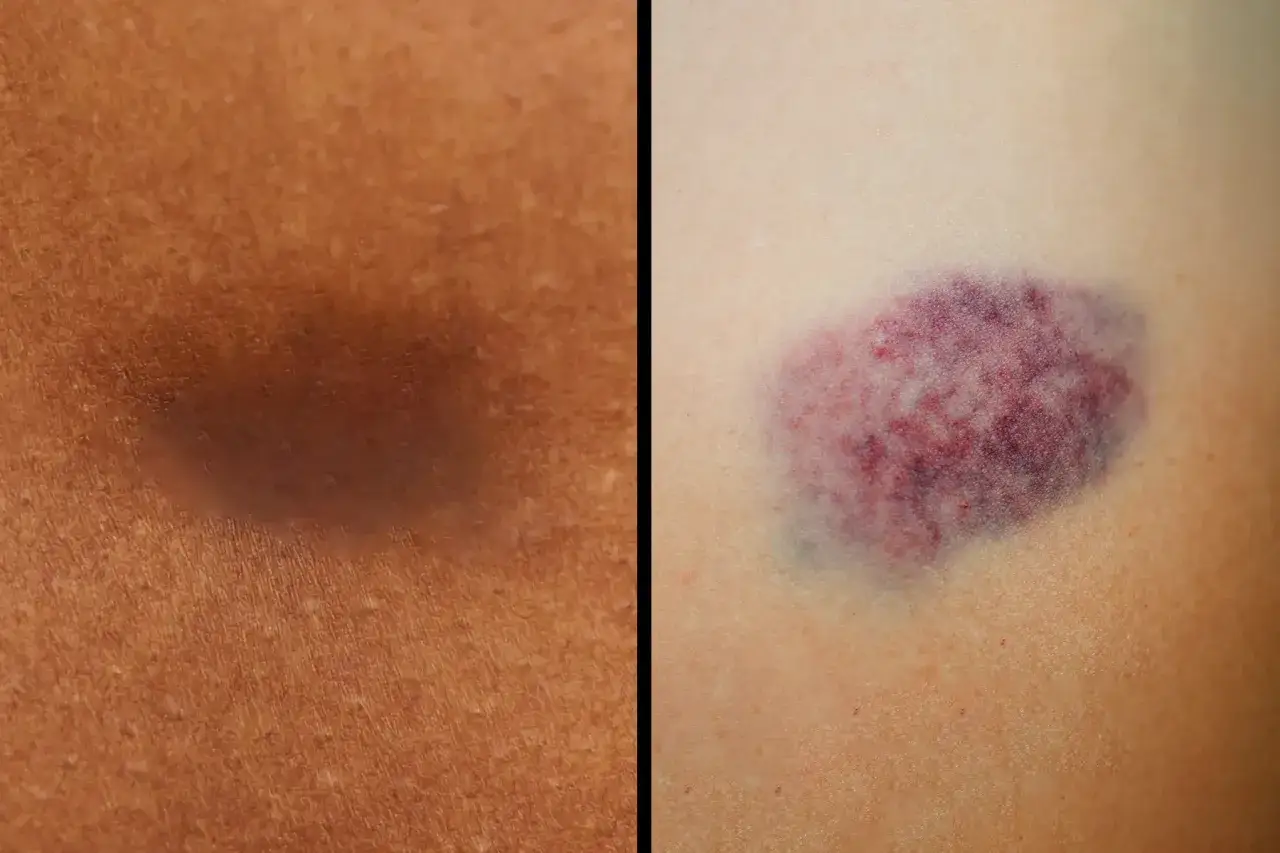 Macchie di lividi su pelle chiara e scura. Un livido viola intenso su pelle chiara, un'ombra scura su pelle abbronzata.