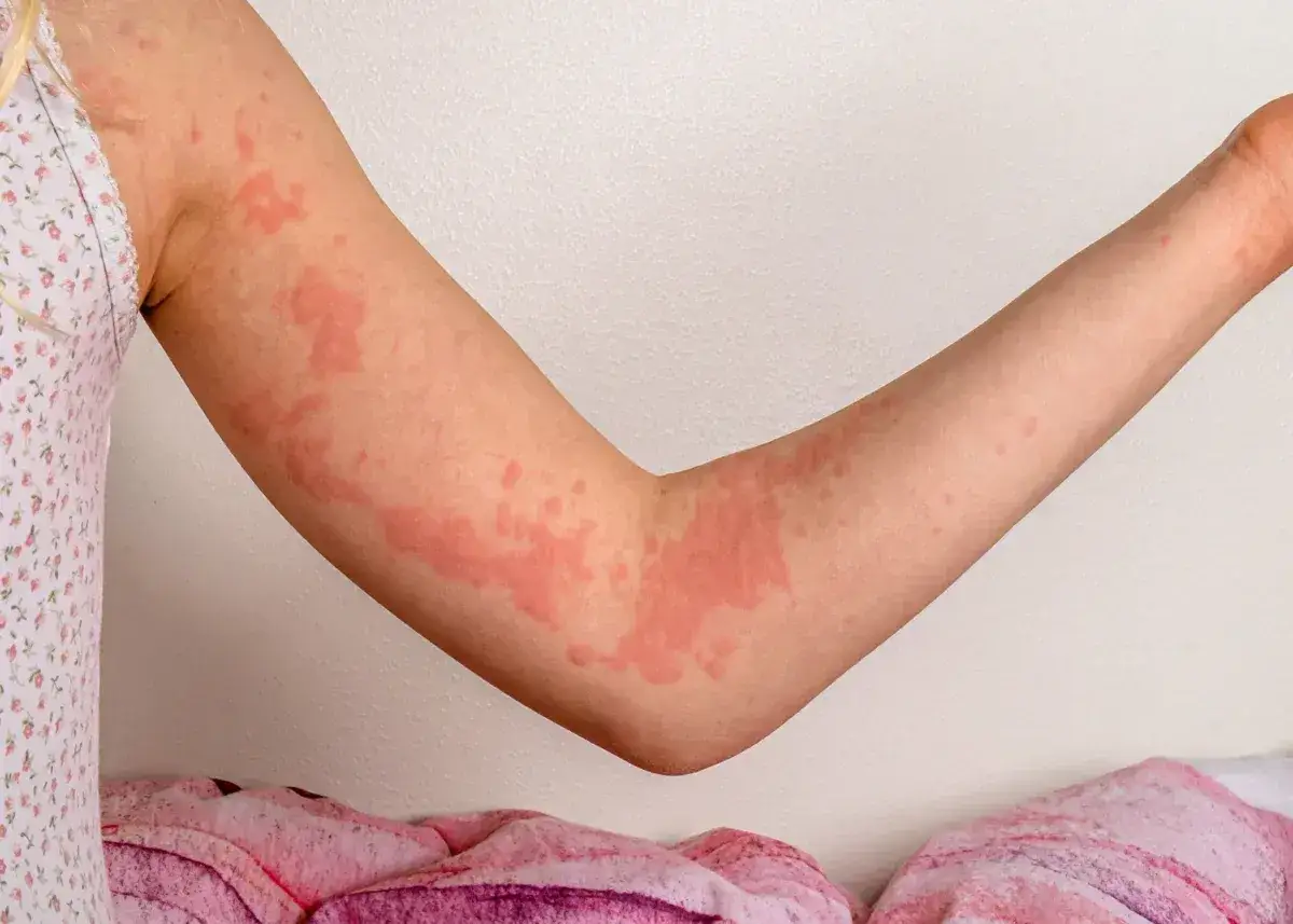 Braccia con pomfi rossi e pruriginosi, segno di orticaria. Scopri come curarla.