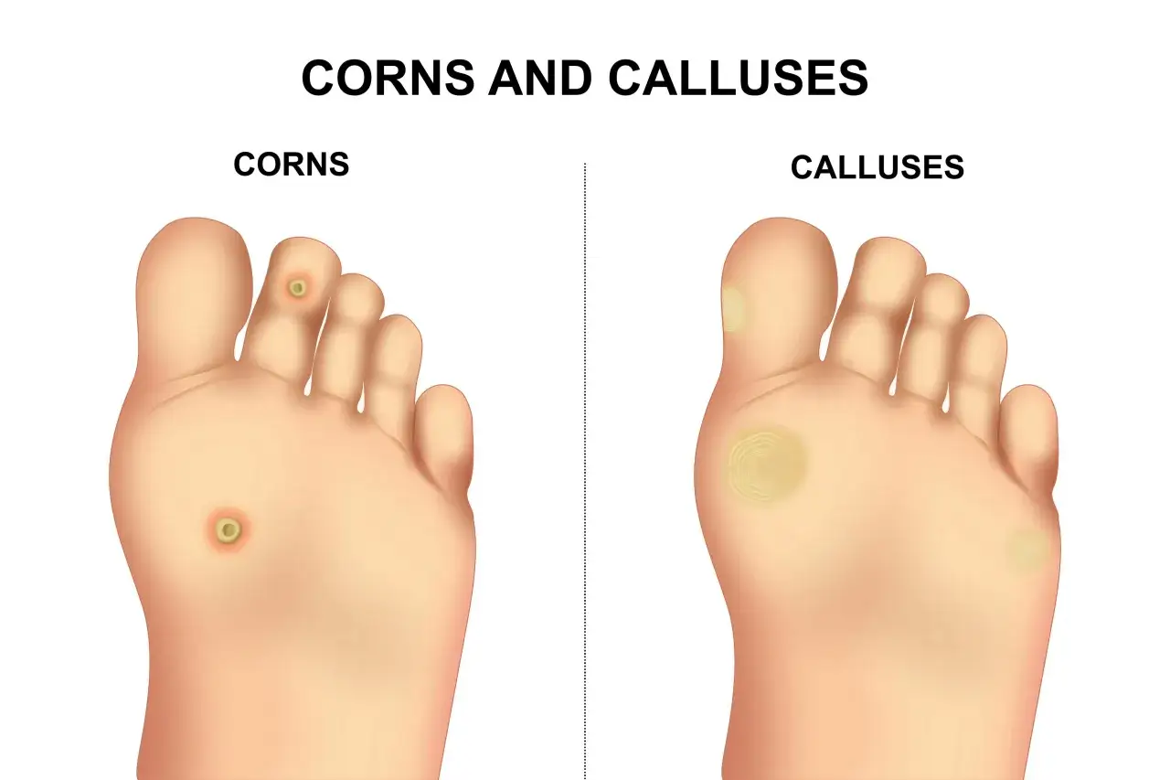 Illustrazione di un piede con calli e duroni. Impara come togliere l'occhio di pernice e i calli per piedi sani.