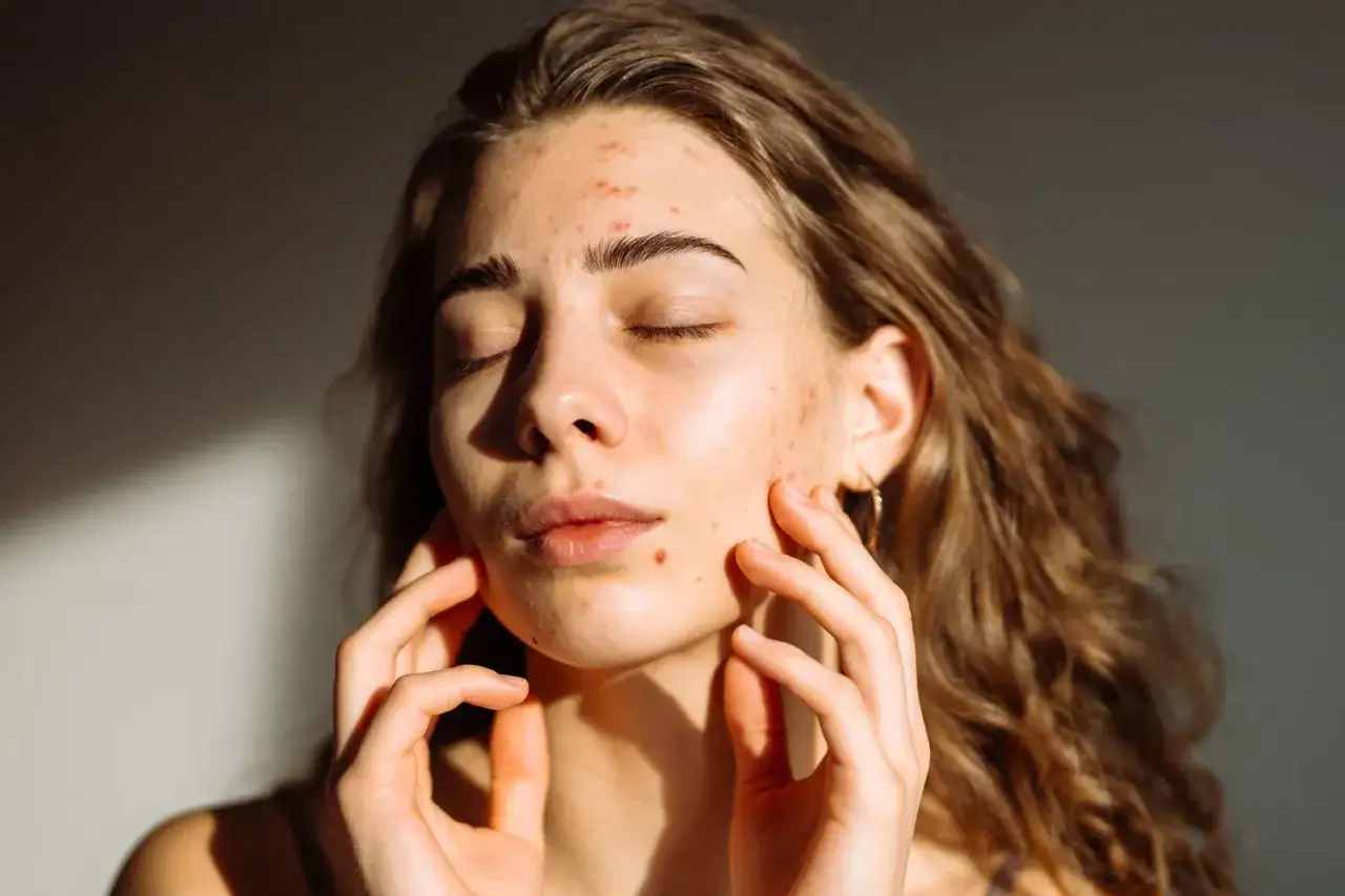 Viso di giovane donna con eritema solare e brufoli, mani che accarezzano la pelle.