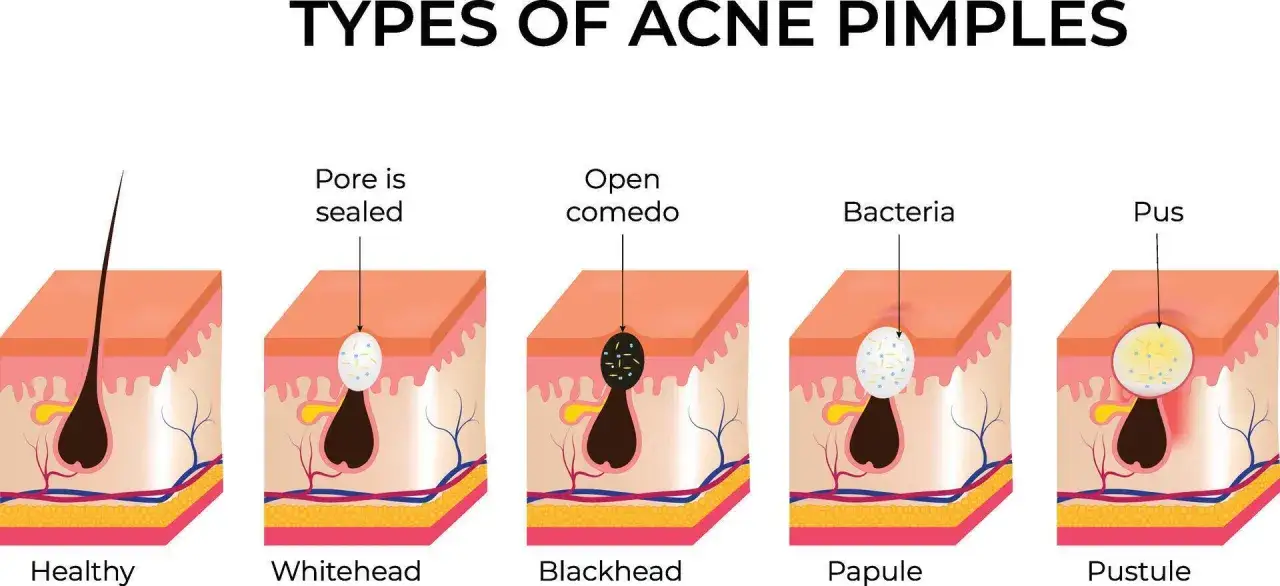 Illustrazione dei diversi tipi di brufoli: pelle sana, comedone chiuso (whitehead), comedone aperto (blackhead), papula con batteri e pustola con pus.