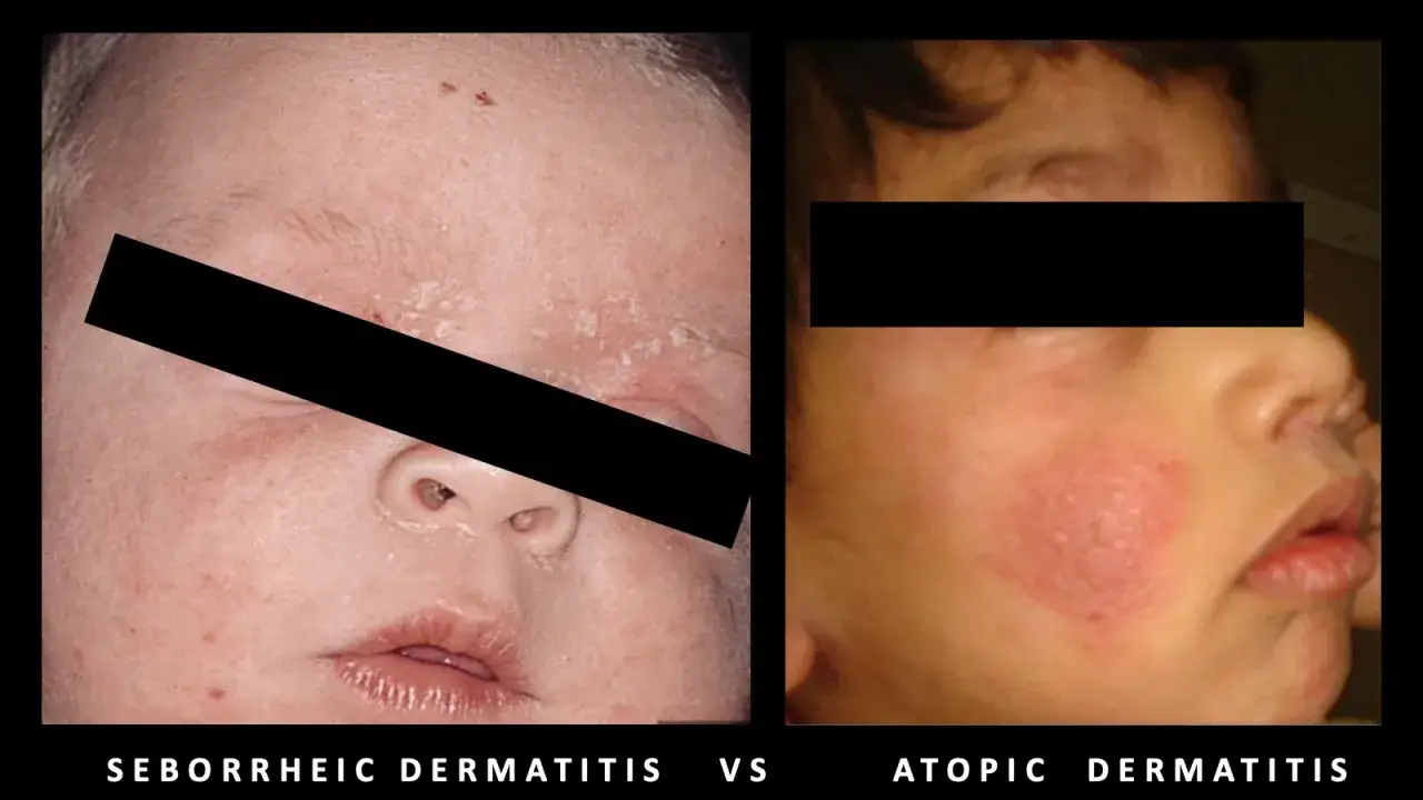 Confronto visivo: dermatite seborroica con squame sul viso e dermatite atopica con arrossamento e gonfiore.
