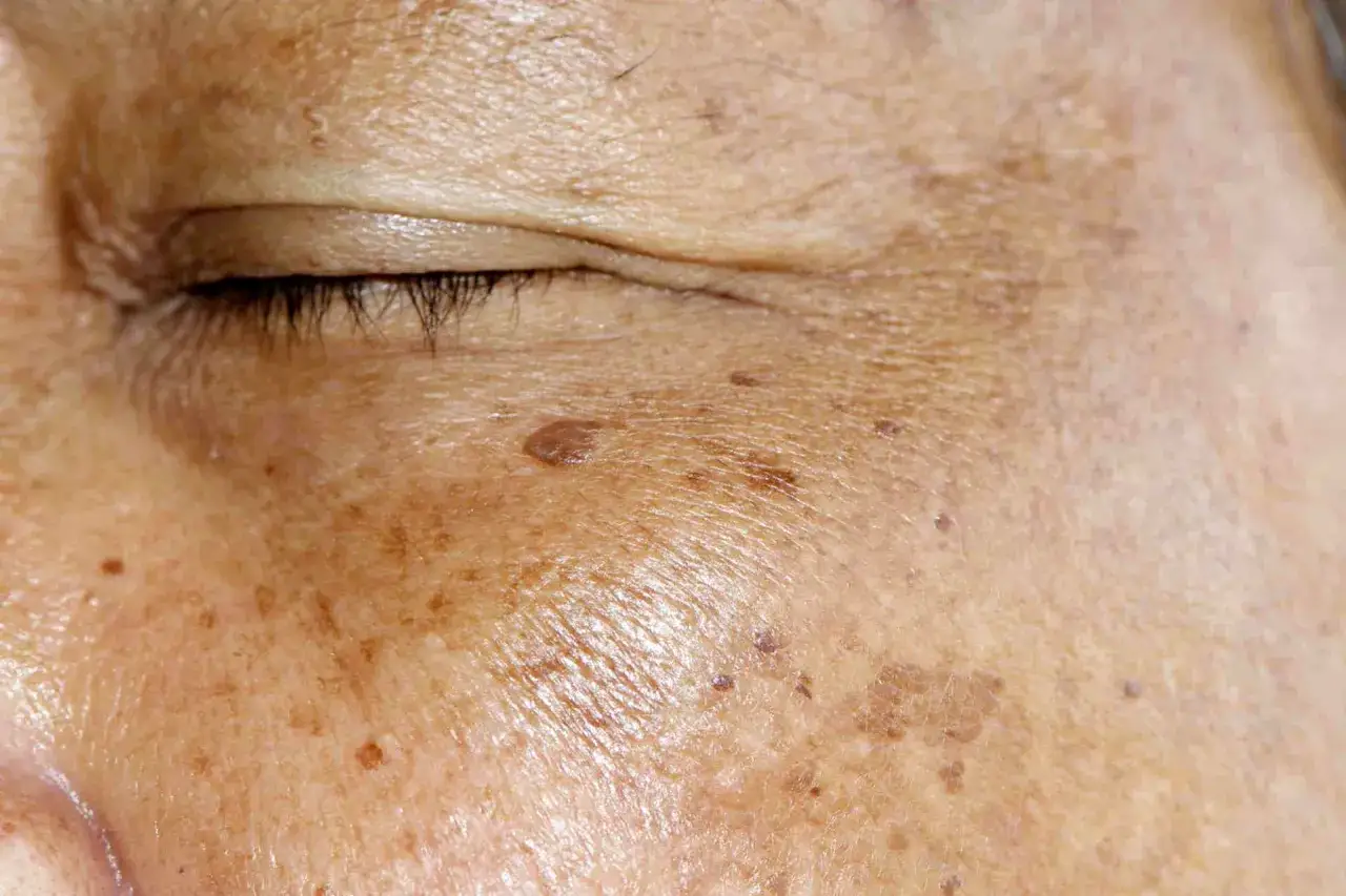 Primo piano di pelle invecchiata dal sole, con lentiggini e macchie scure intorno all'occhio.