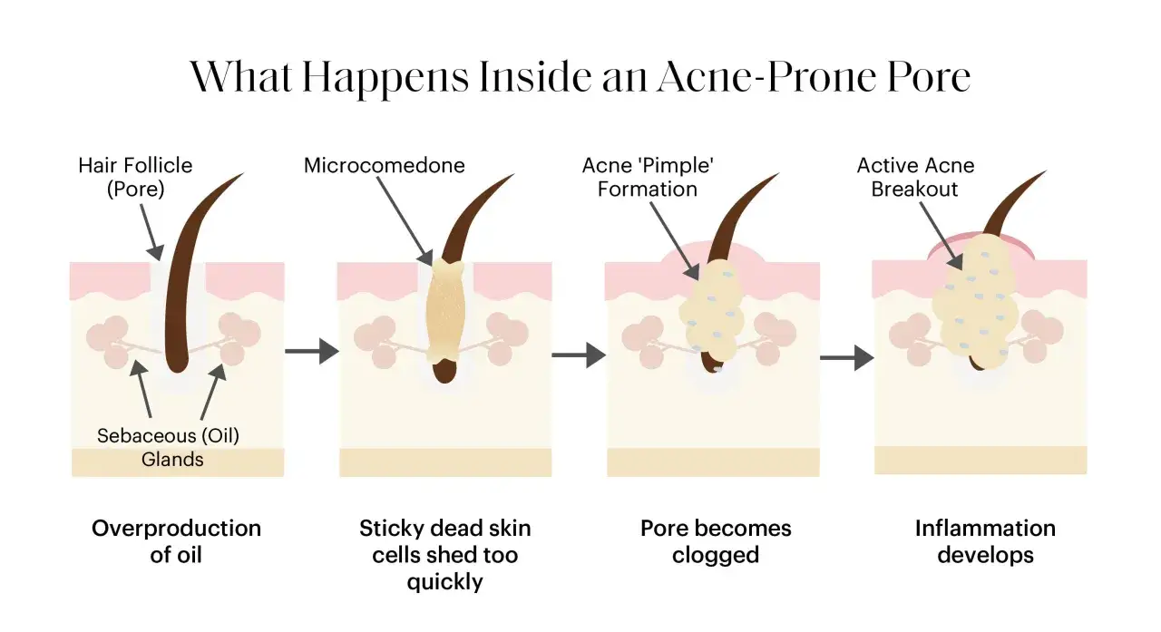 Illustrazione che mostra perchè escono i brufoli: eccesso di sebo, cellule morte che ostruiscono il poro, formazione di comedoni e infiammazione.