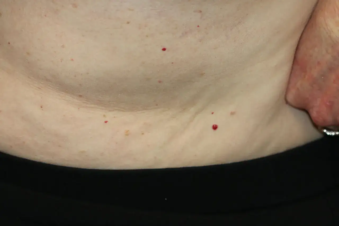 Pelle con piccoli angiomi rubino. Si cercano rimedi naturali per attenuarli.