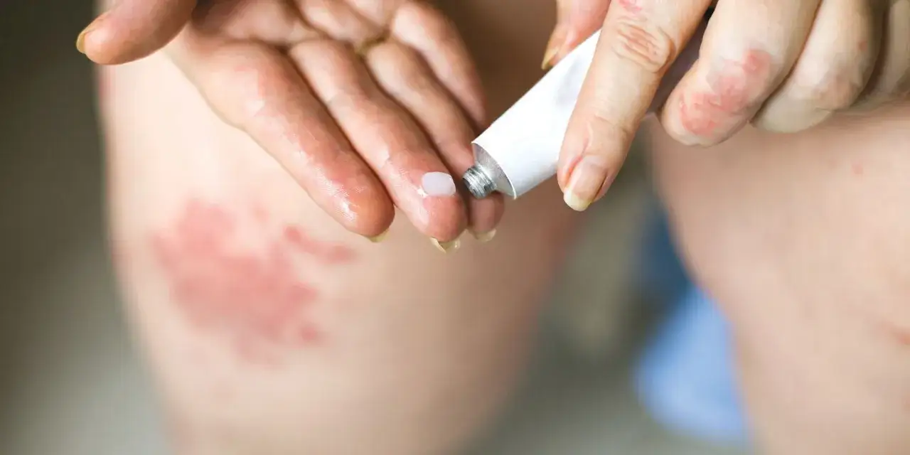 Mani con chiazze rosse e secche, tipiche della dermatite atopica, mentre si applica una crema al cortisone.