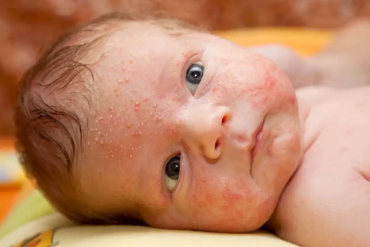 Primo piano di un neonato con eritema e piccoli grani di miglio sui volti e sulla testa.