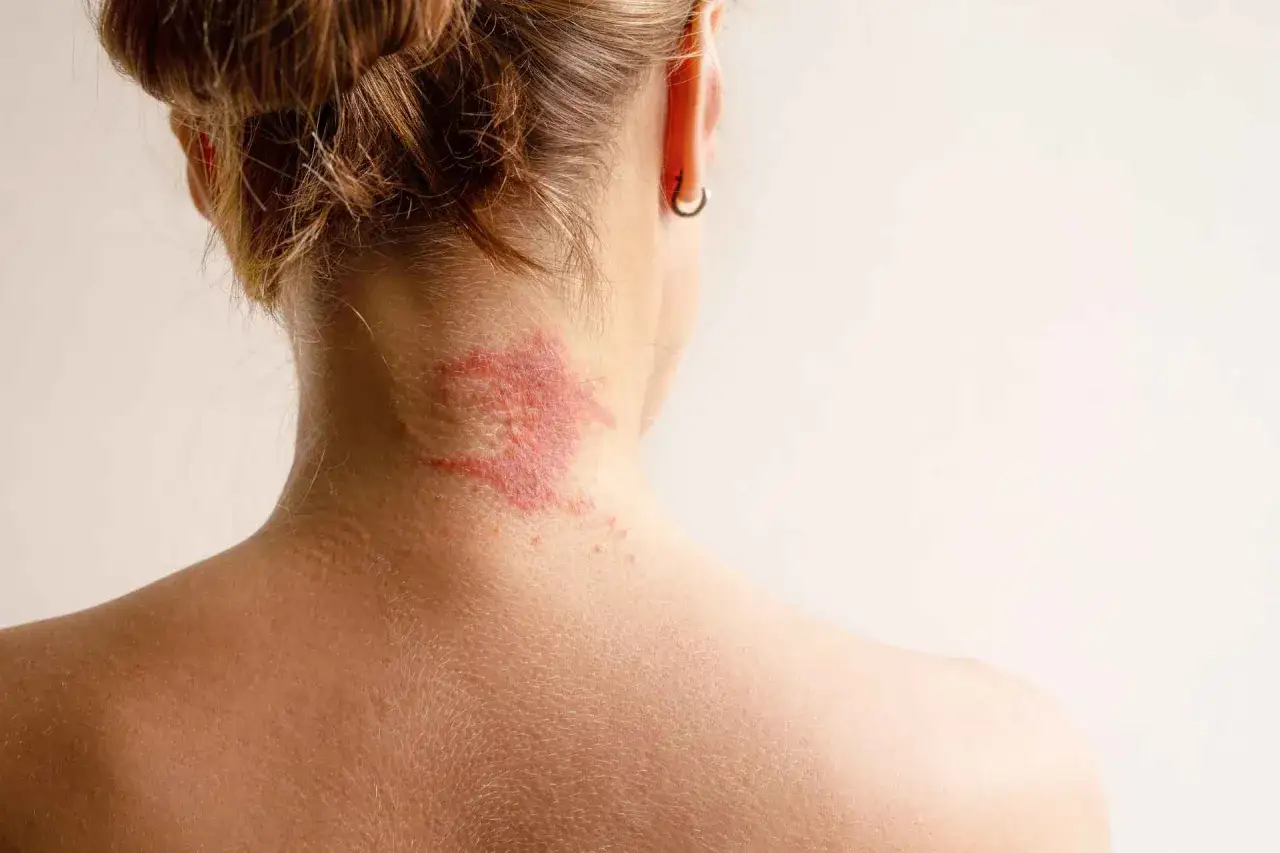 Collo e spalle con arrossamento e irritazione cutanea, sintomo di dermatite acuta.