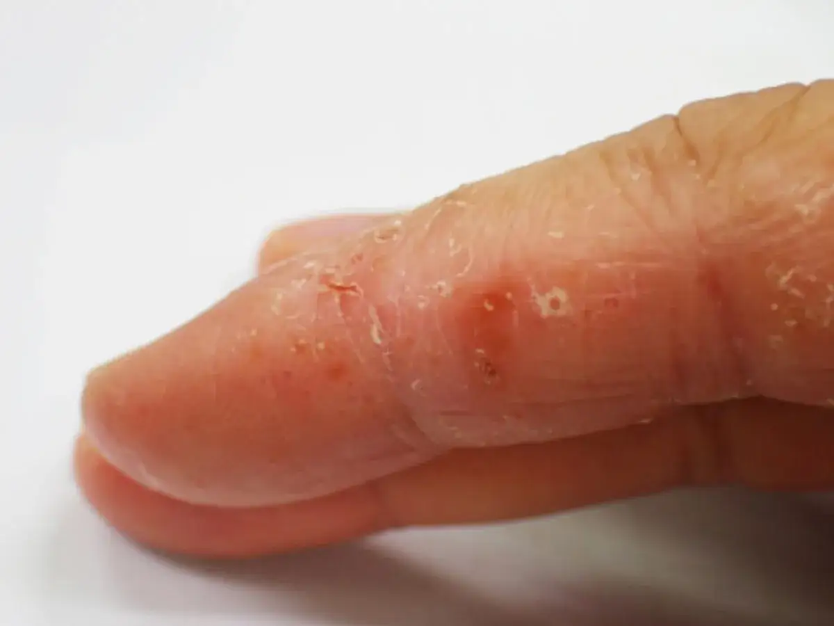 Dito e polpastrelli con pelle secca, screpolata e piccole lesioni, sintomi di disidrosi mani.