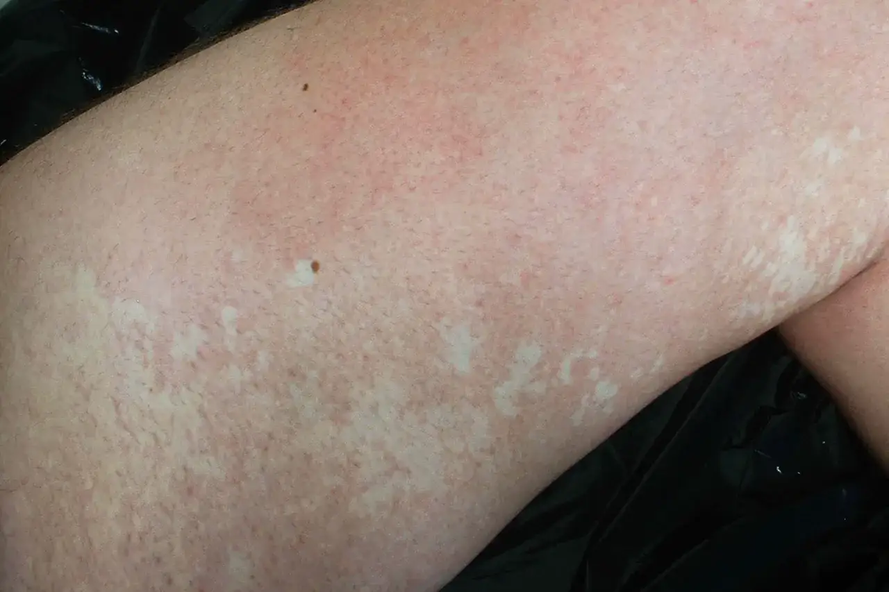 Pelle chiara con puntini bianchi sulle gambe, alcuni nei marroni e rossore diffuso.