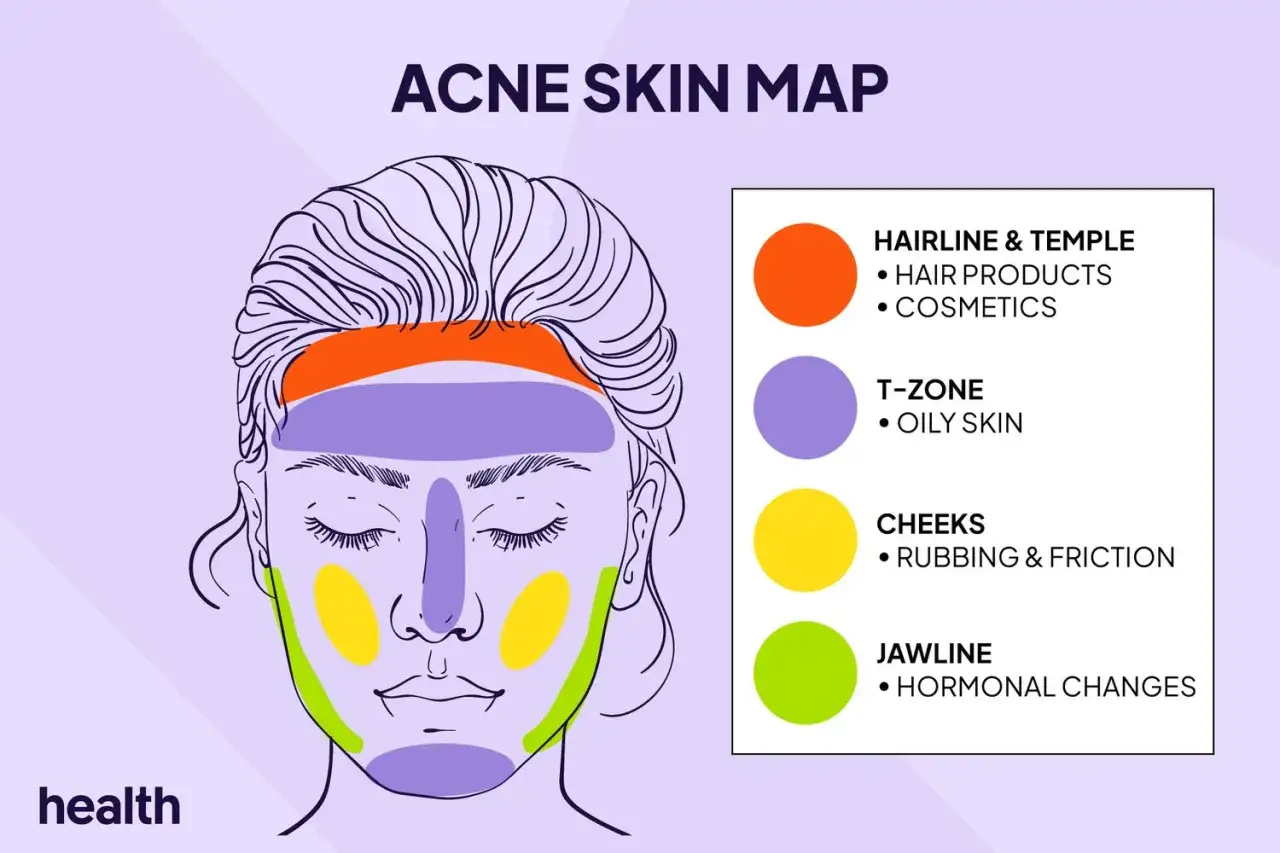 Mappa dell'acne: le zone gialle sulle guance indicano sfregamenti e attriti che possono causare brufoli.