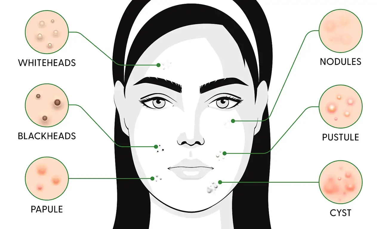 Illustrazione che mostra diversi tipi di brufoli: whiteheads, blackheads, papule, noduli, pustole e cisti. La durata di un brufolo varia.