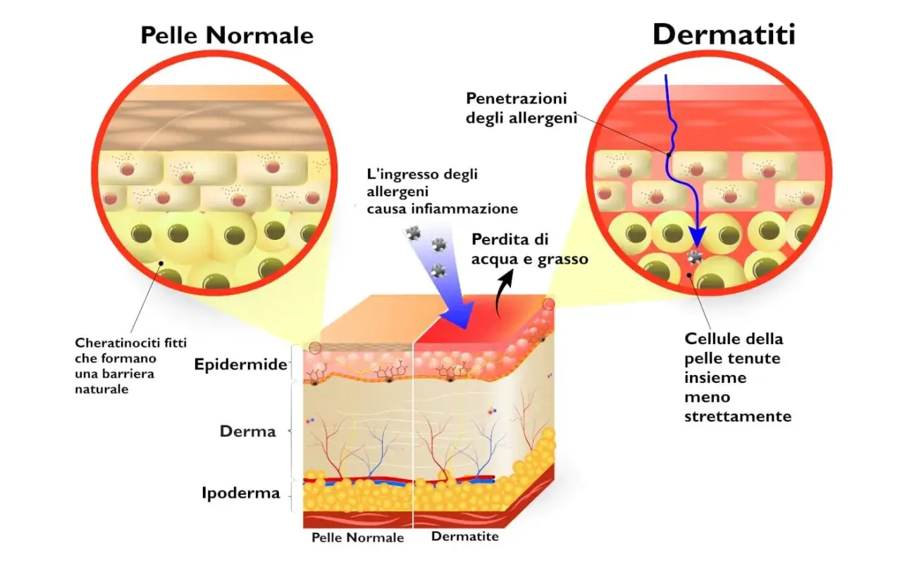 Confronto tra pelle normale e dermatite: gli allergeni penetrano, causando infiammazione, perdita di acqua e grasso.