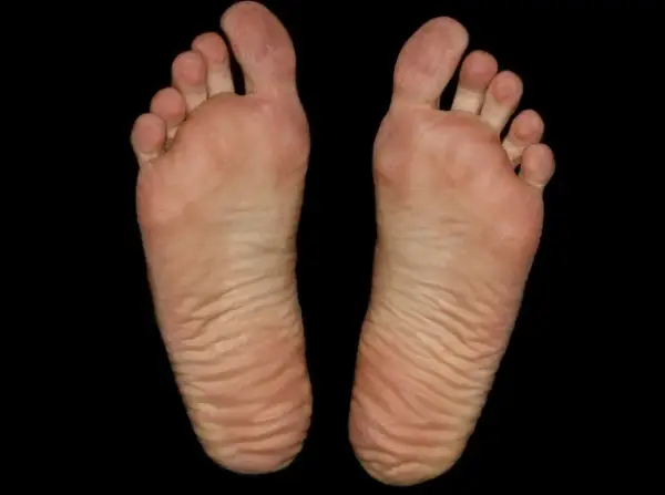 Piante dei piedi con evidenti calli e rughe, segno di lunghe camminate.
