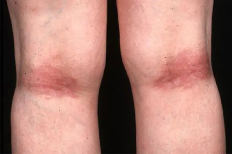 Gambe con arrossamento e ispessimento cutaneo, tipici della dermatite atopica.