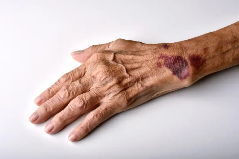 Mano anziana con evidenti segni di atrofia cutanea e lividi sul dorso, pelle sottile e rugosa.